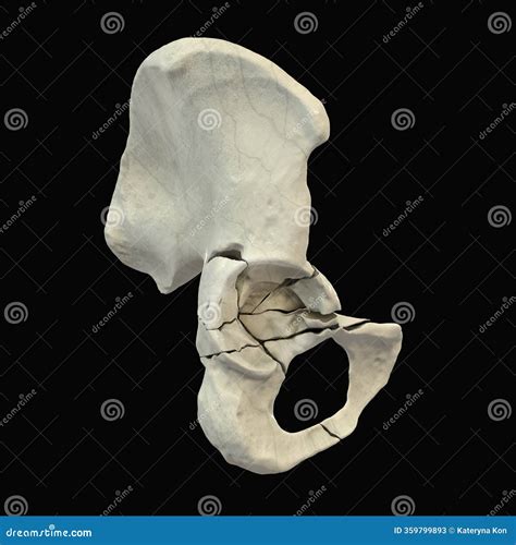 Acetabulum Fracture, 3D Illustration Stock Illustration - Illustration of pelvic, black: 359799893