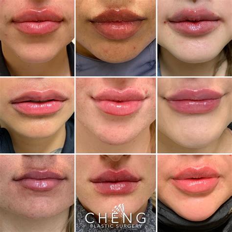 Lip Filler Shapes 💋 | Lip fillers, Facial aesthetics, Lip injections