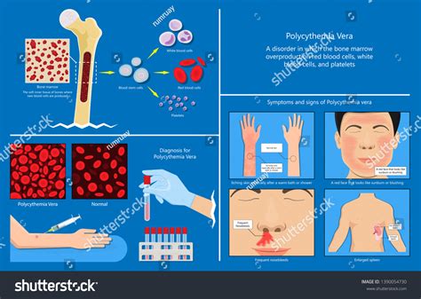 Polycythemia Vera Pv Blood Clots Cancer Stock Vector (Royalty Free) 1390054730 | Shutterstock