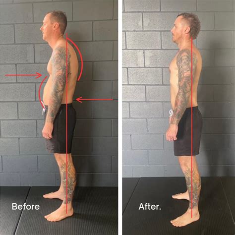 Do Kyphosis Correctors Fix Hunchback Posture? — Functional Patterns ...