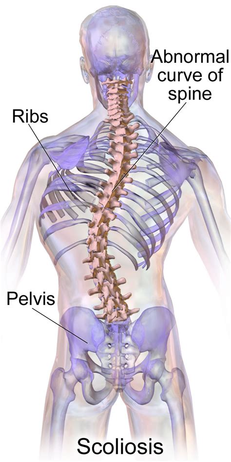 Scoliosis - Adults & Children - Causes, Treatment, Brace, Exercise
