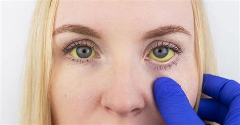 What Causes Yellowing Of The Eyes at Randy Eubanks blog