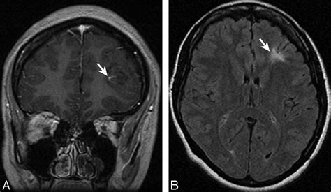 Brain Parenchymal Signal Abnormalities Associated with Developmental Venous Anomalies: Detailed ...