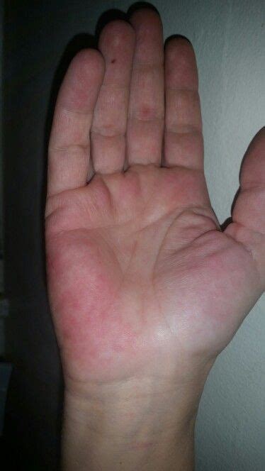 lupus hand rash