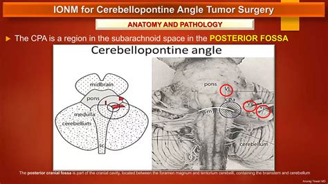 IONM for Cerebellopontine Angle Tumor Surgery | PPTX