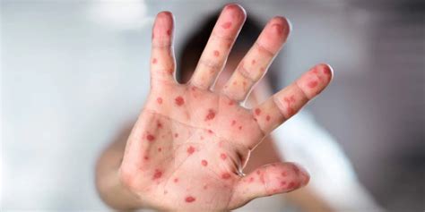 Las Vegas traveler with measles exposes airports in 2 other states