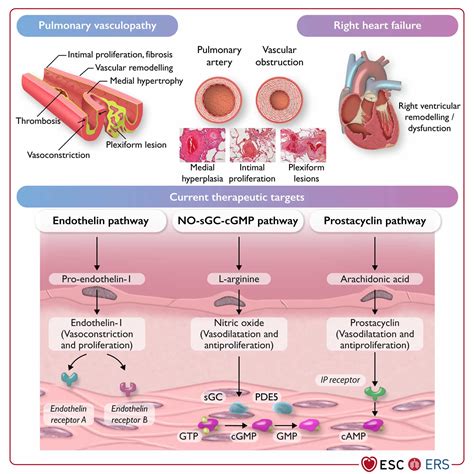Pulmonary arterial hypertension, causes, symptoms, diagnosis, treatment ...