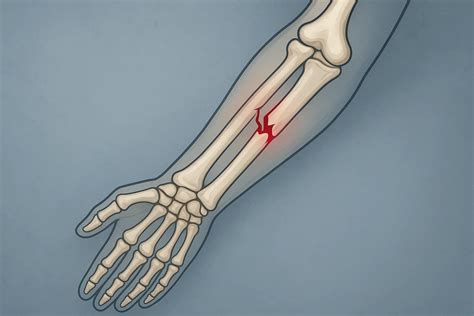 Radius Fracture 的图像结果