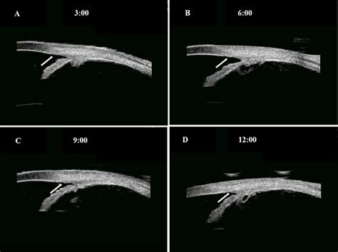 Angle Recession 的图像结果