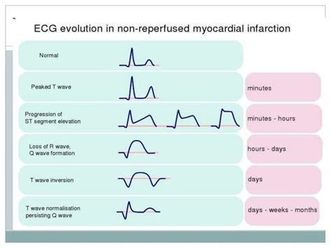 Image result for STEMI Algorithm