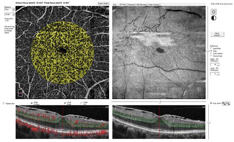 Correlation between Visual Acuity and Optical Coherence Tomography ...