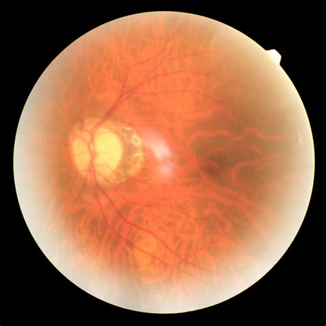 Diabetic Eye Problems 的图像结果