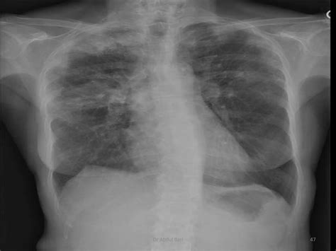 Image result for Chest X-Ray Tutorial