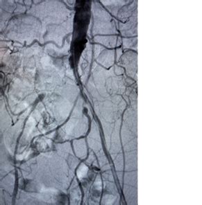 LifeStream™ Balloon Stent | Accurate Iliac Treatment | BD