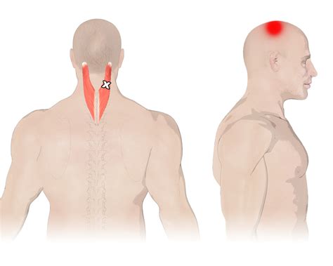Splenius 的图像结果