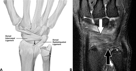 Scapholunate Ligament Injuries - Journal of Hand Surgery Global Online