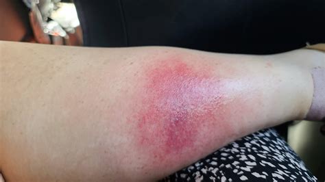 Wasp Sting Infection Signs