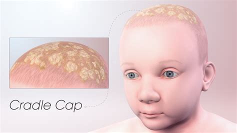 Cradle Cap: Symptoms, Causes, and Treatment - Scientific Animations