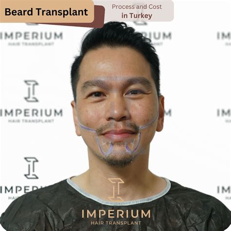 Beard Transplant in Turkey - Imperium Hair Transplant Clinic - Turkey