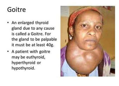 Image result for Thyroid Prediction Using Machine Learning