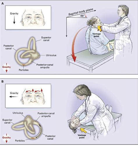 Canalith Repositioning Maneuvers