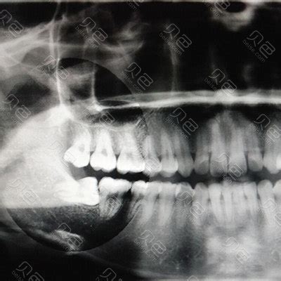消失的牙齿，论牙齿X光片的重要性！ - 知乎
