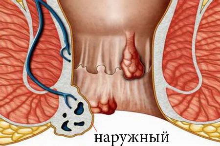 Наружный геморрой: симптомы и лечение по стадиям + фото
