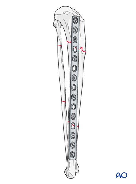 Compression Plate Ao 的图像结果