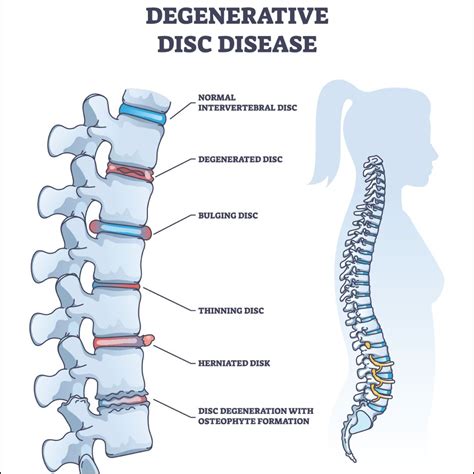 Degenerative Disc Disease: Causes, Risk Factors, Symptoms, Treatment