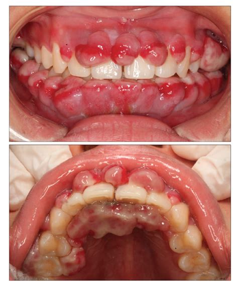 妊娠期多发性牙龈瘤1例