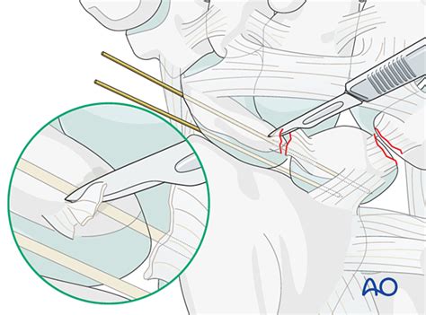 Image result for Lunate Dislocation Reduction