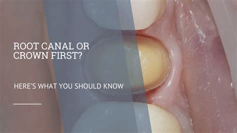 Root Canal Treatment Side Effects: Myths vs. Reality