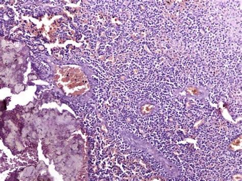 Image result for Devitalized Tissue Example