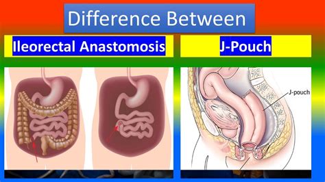 Image result for pouchoscopy