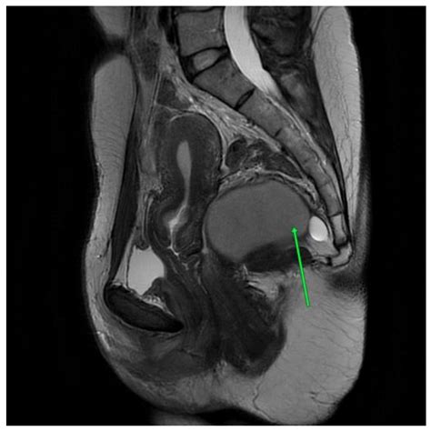Two Cases of Symptomatic Tailgut Cysts