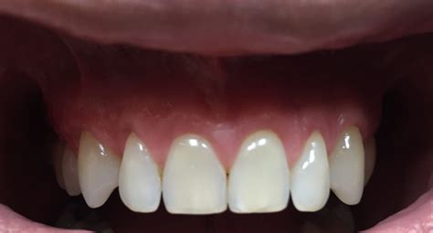 Gum Recession- How To Grow Back Your Lost Gums