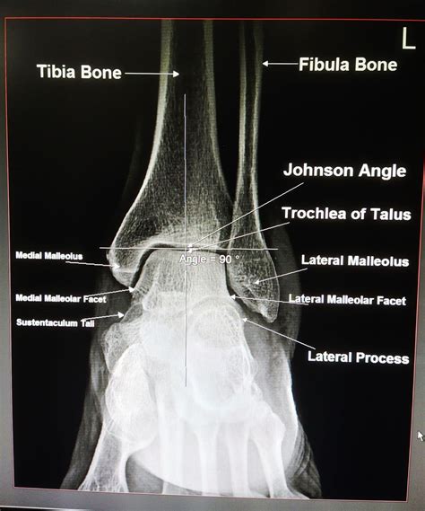 Ap Ankle X Ray Anatomy