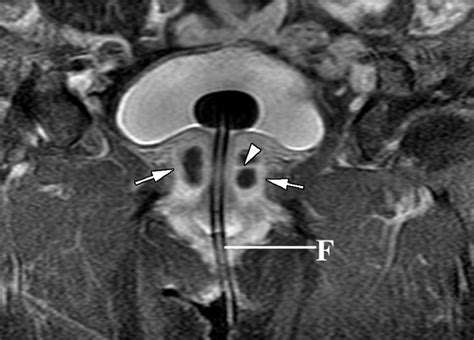 Imaging of Female Urethral Diverticulum: An Update | RadioGraphics