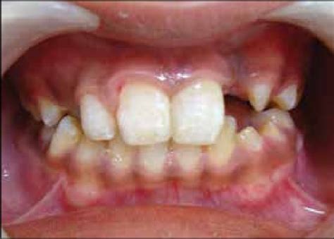 Splint Removal 的图像结果