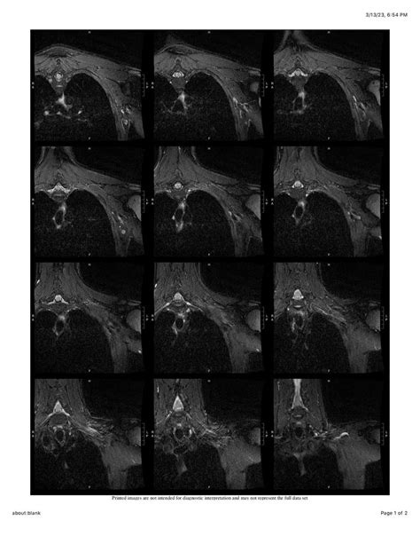 Chest MRI Without Contrast: Distal Clavicular Osteolysis of Left Clavicle : r/Radiology