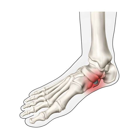 Accessory Navicular Syndrome: Complete Treatment Guide, Exercises & Best Shoes (2025)