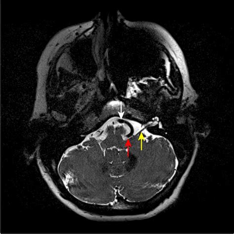 Hemifacial spasm | Neurosurgery Inselspital Bern