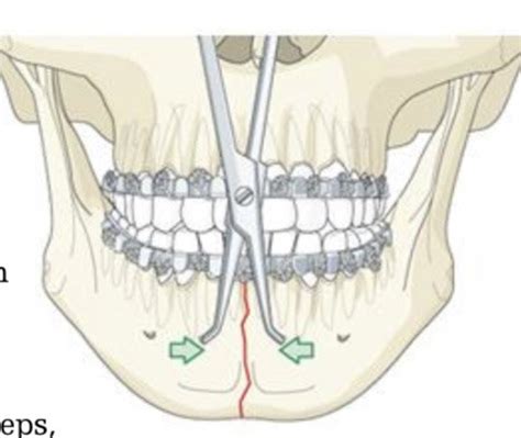 Image result for Lrather Fixation