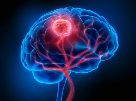 Catching brain diseases early could save your life