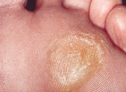 Image result for How to Remove Calluses From Feet Fast