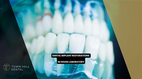 Dental Implant Restorations Teeth Replacement Solution Town Hall