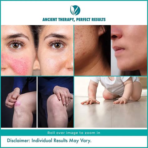 Barphani EczoNil Ointment - Eczema Dermatitis Ringworm Fungal Infectio