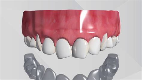 Invisalign Animation 的图像结果