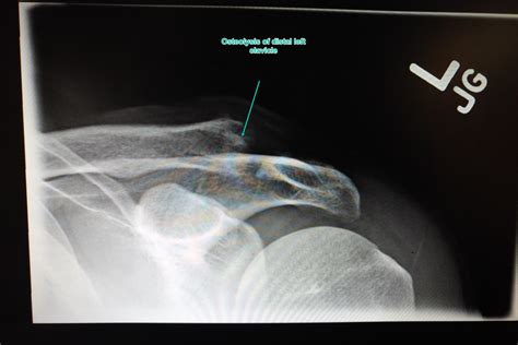 Osteolysis of Distal Clavicle | Sport Med School