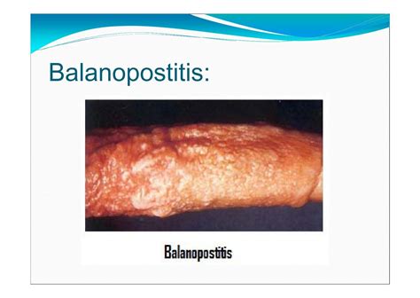 Balanopostitis: